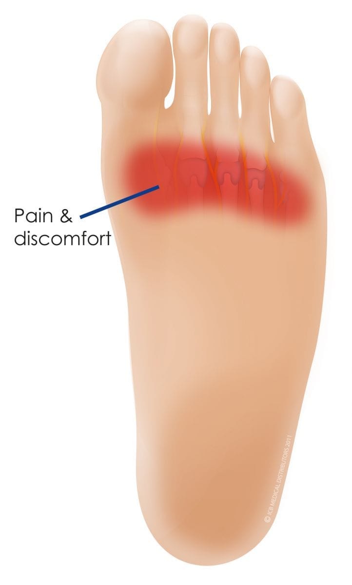 metatarsalgia-symptoms-min