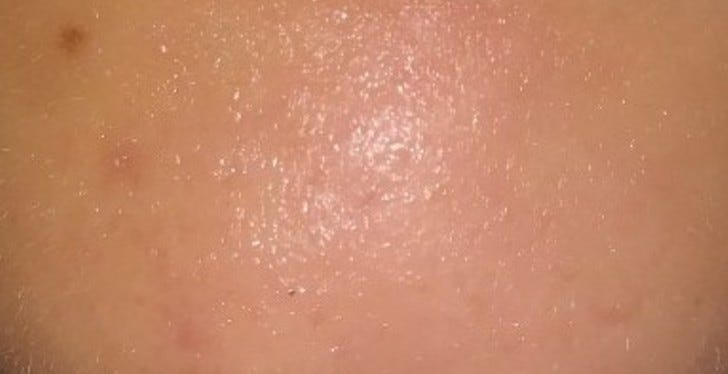 A Slow Respondent Responding To Minoxidil After Daily Retinol Before