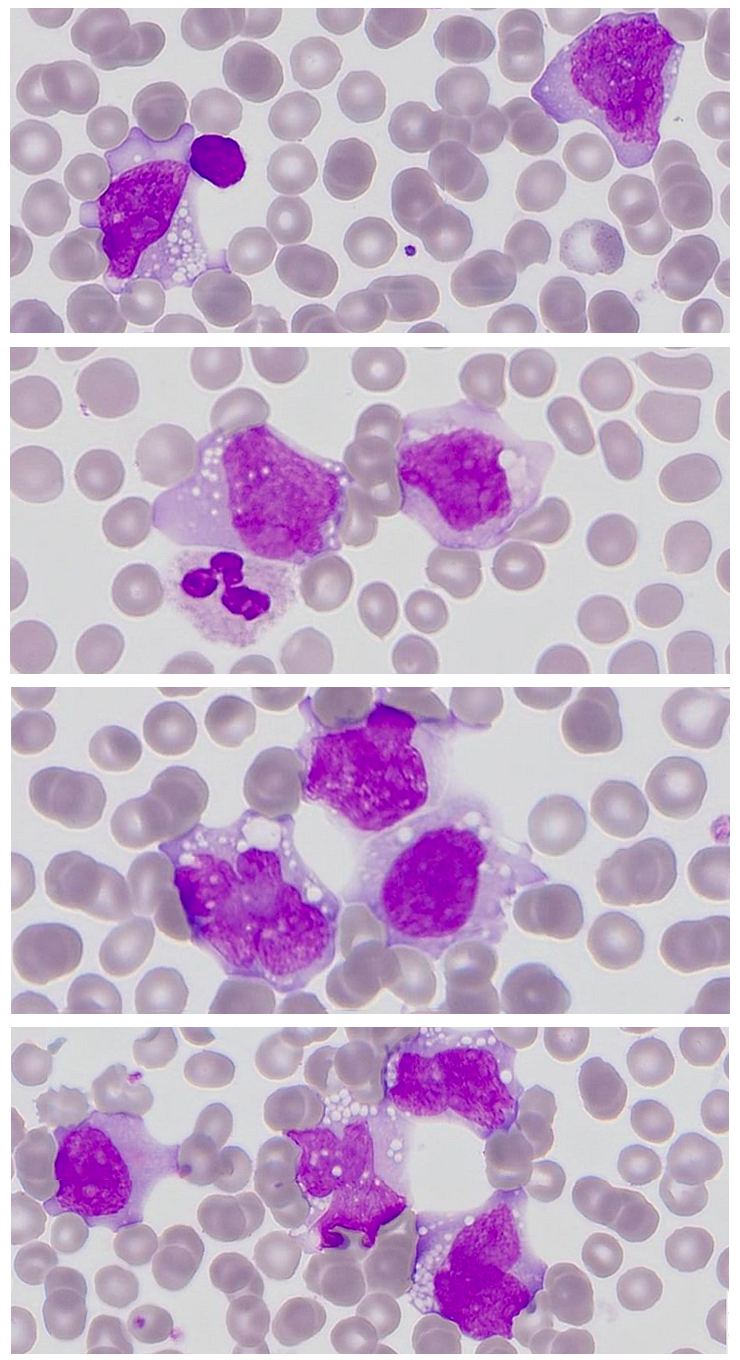 Uncovering a rare case of Acute Monocytic Leukemia: Can you spot the promonocytes in a blood smear?