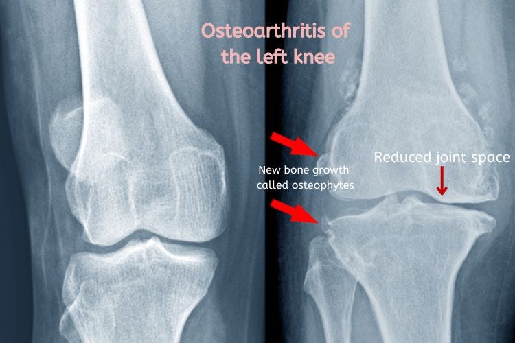 X-ray of left knee joint showing changes of osteoarthritis