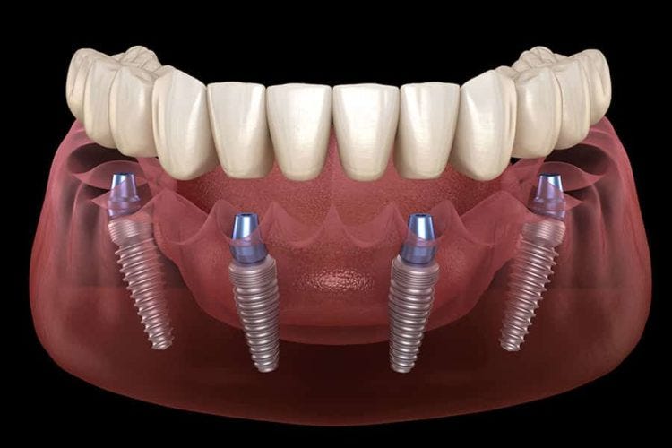 Dental implants photo