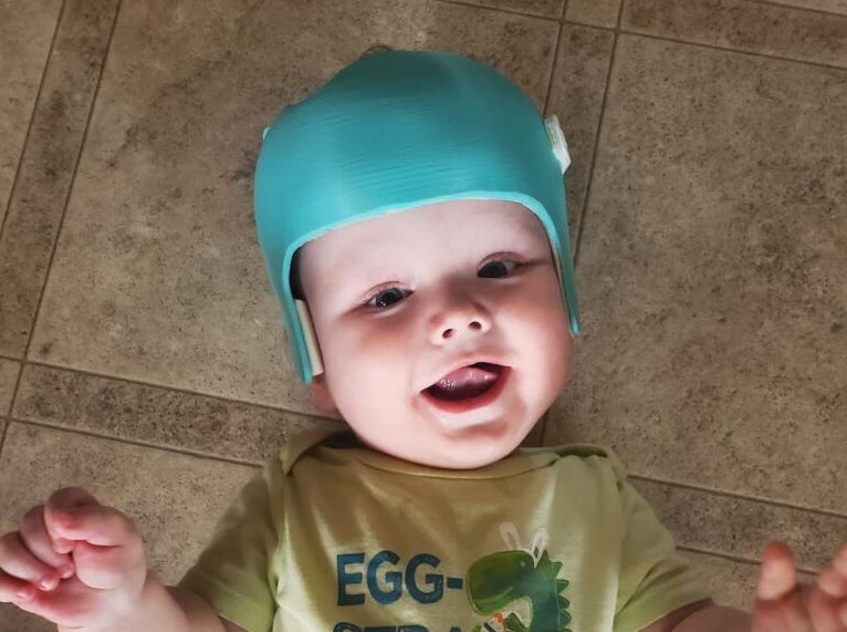 Baby Rowan, infant patient genetically diagnosed with SLC13A5 epilepsy
