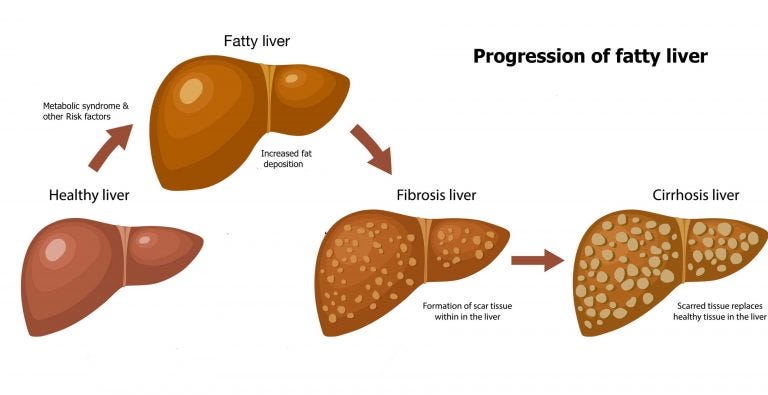Complications & Causes of Fatty Liver