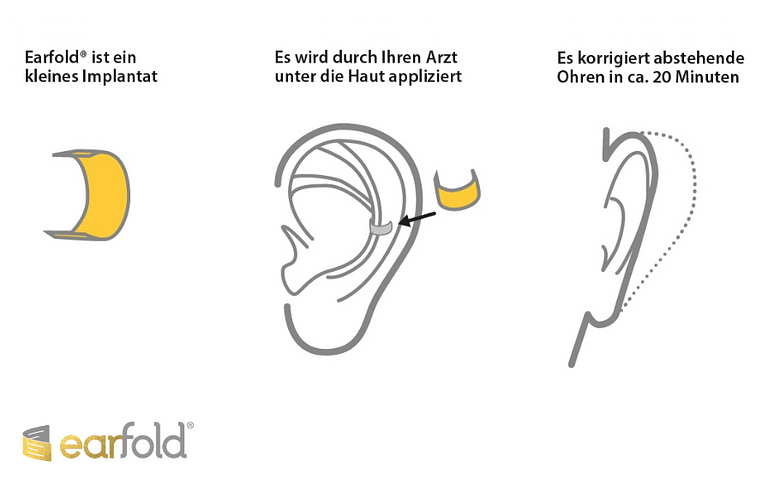 Eine neue Behandlung für abstehende Ohren. 
