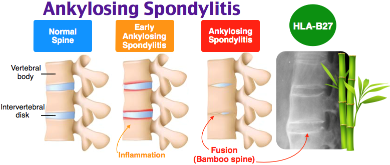 Image result for Ankylosing Spondylitis