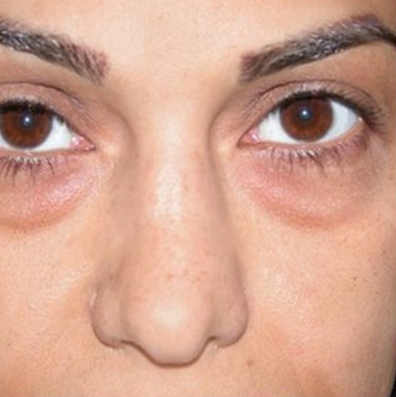 Dark Circles Under Eyes