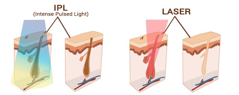 Ipl Laser Hair Removal Reviews: Unbiased User Experiences