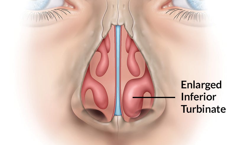 Normal turbinates (pictured left) vs. enlarged turbinate (right)