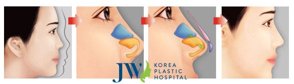 Nâng mũi Hàn Quốc có bền lâu không