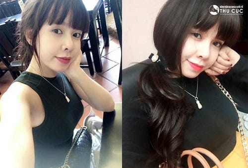 Không muốn phải thường xuyên make-up để che đi khuyết điểm đôi mắt sụp mí, Diễm My (22 tuổi, Hà Nội) đã tìm hiểu kỹ lưỡng mọi nguồn thông tin và lựa chọn Thu Cúc là điểm đến tân trang nhan sắc.