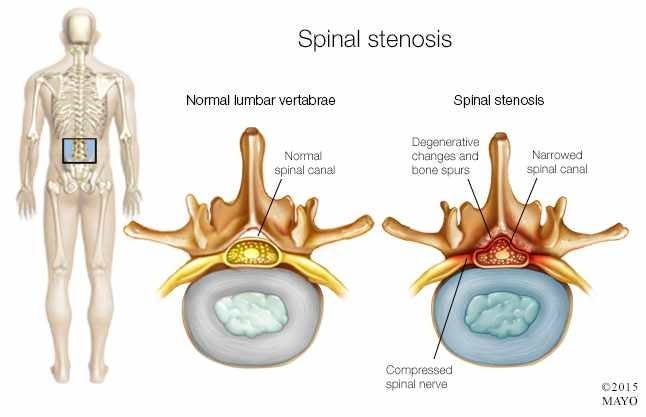 Spinal Stenosis 
