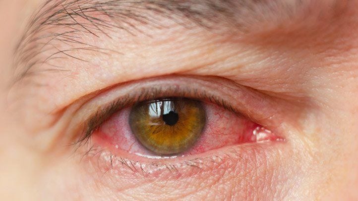 Dry eye that appears red, causing irritation and pain