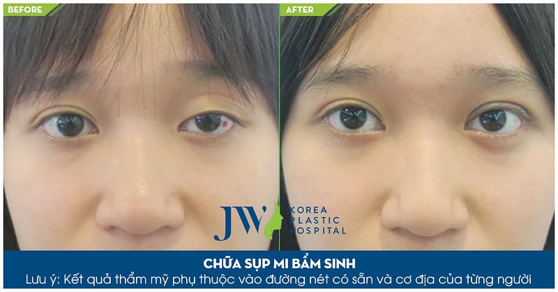 Chống sụp mí mắt 