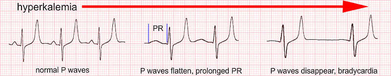 5 ECG Changes of Hyperkalemia you Need to Know – Acadoodle – Medium