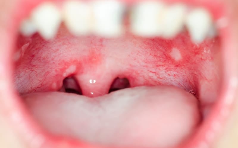 This image is about the Signs Of Infection In Your Mouth