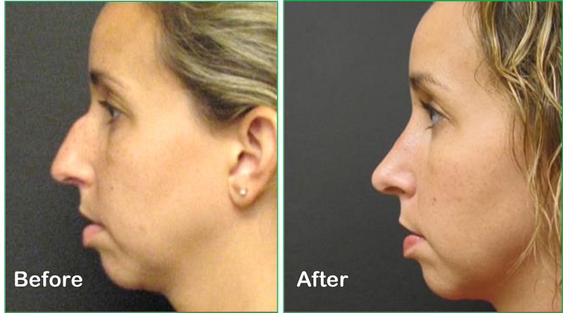 Birmingham-Cosmetic-Rhinoplasty