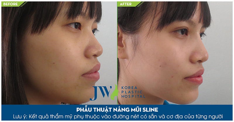 Nâng mũi Hàn Quốc có bền lâu không
