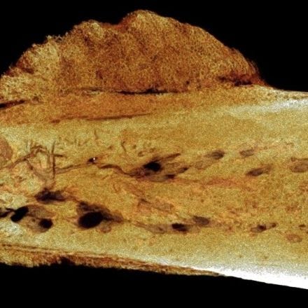 Fossil evidence reveals that cancer in humans goes back 1.7 million years