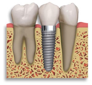 Dental Implant Graphic