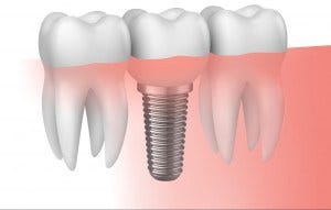 implantes-dentales-sevilla-e1461258426239