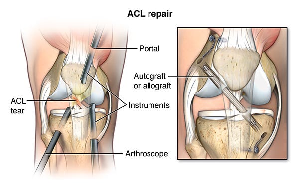 ACL Injury doctor in Lahore, Orthopedic Surgeon, Best Orthopedic Surgeon