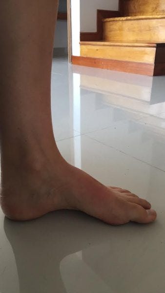 footarch