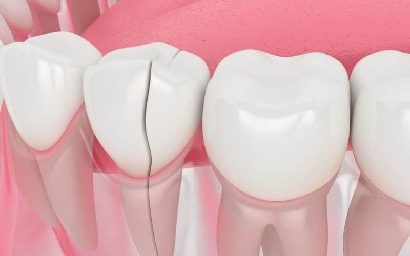 This image is about how to fix a cracked tooth naturally