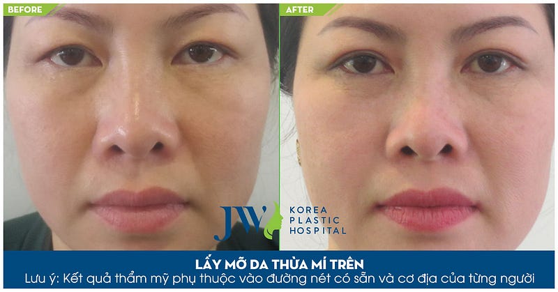 Chống sụp mí mắt 