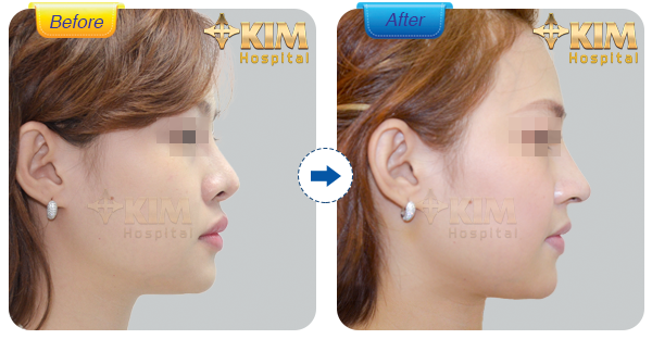 Nâng mũi bằng sụn tự thân có tốt không