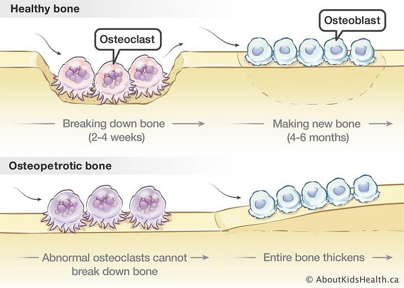 osteopetrosis