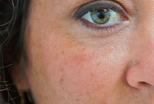 Age Spots