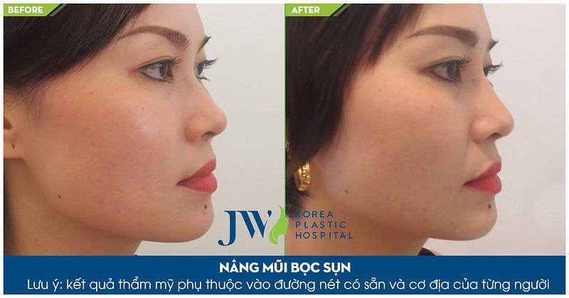 Nâng mũi Hàn Quốc mất bao nhiêu tiền