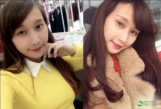 Diện mạo của Hải Lâm như được "lột xác" sau khi thực hiện cắt mí chuẩn Hàn tại Thu Cúc. Đôi mắt vốn mệt mỏi của cô nàng giờ đã long lanh, trẻ trung hút hồn