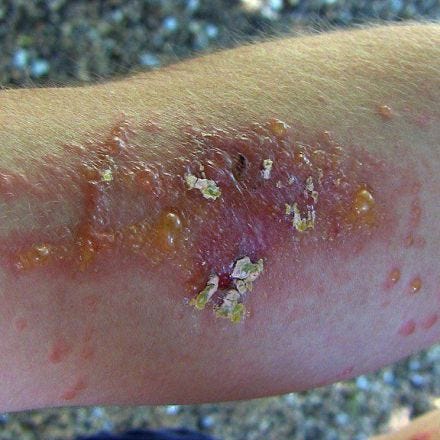 A retired scientist explains the trick to never getting a poison ivy rash again