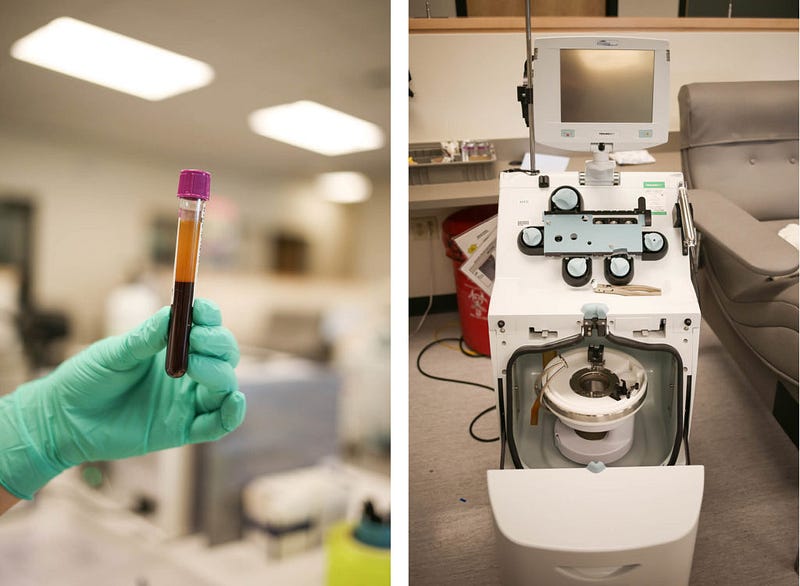 Plasma donation can happen one of two ways. The first is via plasmapheresis, where blood is withdrawn from the donor, run through a machine that separates the plasma out, then returned back to the donor. Those who give this way often describe an internal chill when the blood enters back into their body at a colder temperature. The second method of plasma donation is done via a traditional blood draw. Once the blood is removed, the platelets, white blood cells and plasma naturally separate from the red blood cells to form a distinct tan-colored layer in the upper portion of the sample. This layer can then be further separated to remove the plasma. 