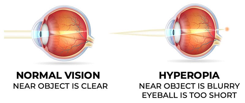 Diagram of a hyperopic eye.