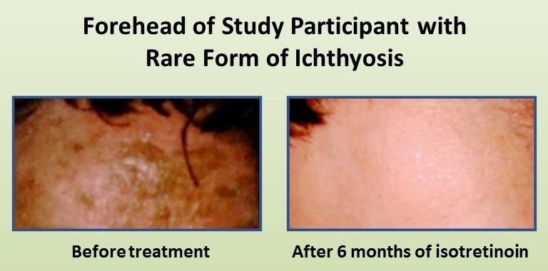 Ichthyosis 