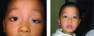 Chống sụp mí mắt