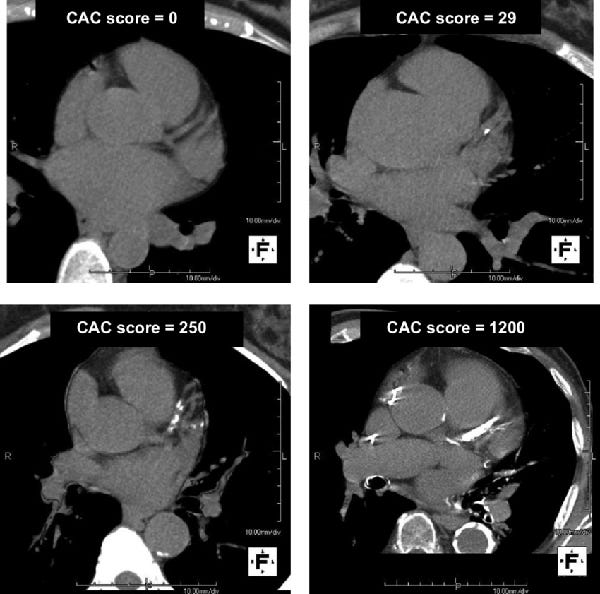 Coronary Artery Calcium Scoring Is It Useful Dr Ross Walker   0*jZ0HaKNDf7IsmNn3