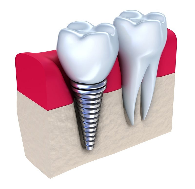 dental implant.jpg