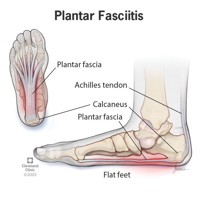 Plantar Fasciitis, Flat Feet