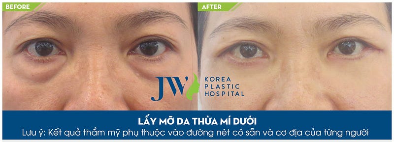 Chữa bọng mắt to