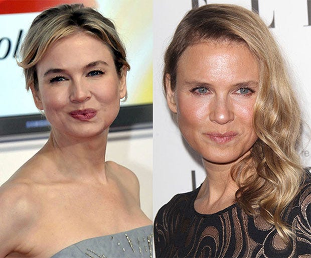 The 'before and after' image used in stories regarding Renees face.
