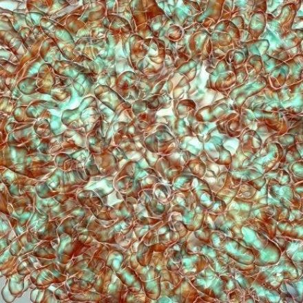 93% of leukaemia patients in remission after an experimental T cell therapy