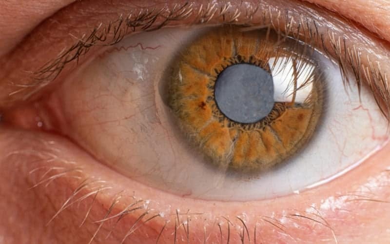 This image is about is it possible to cure cataracts without surgery