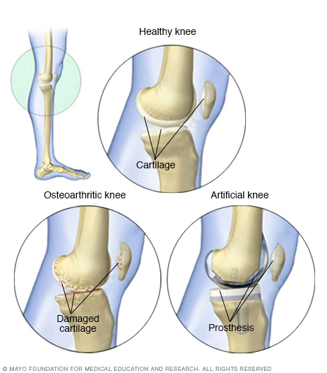 Osteoarthritis 