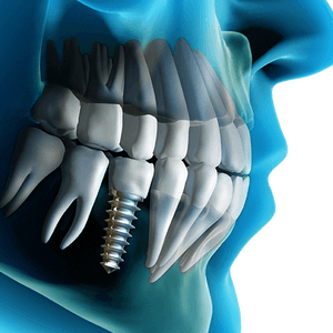 clinica-dental-magallanes-madrid-implantes-03