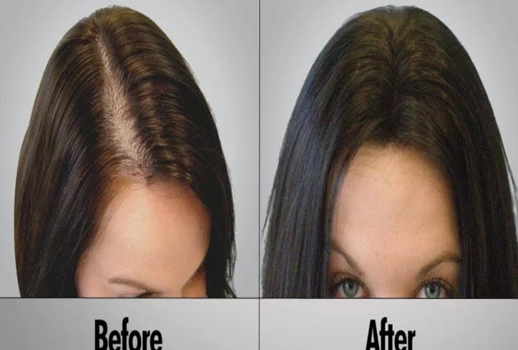 Symptoms & Causes of Hair Fall Treatment