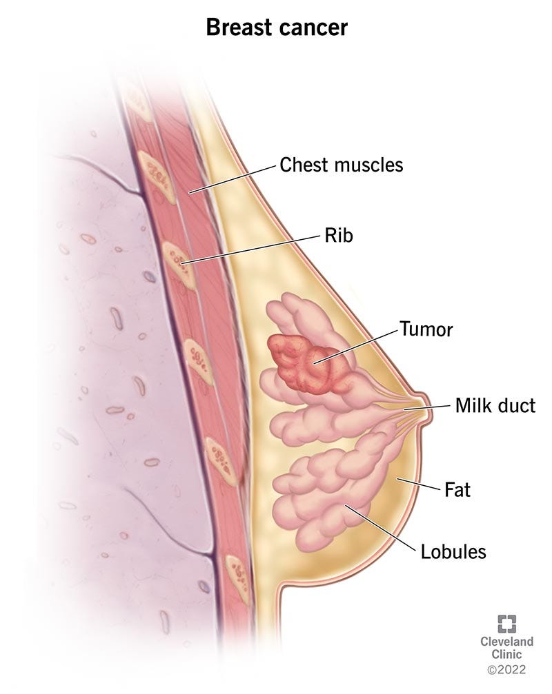 Scientific diagram of the female breast with a tumour