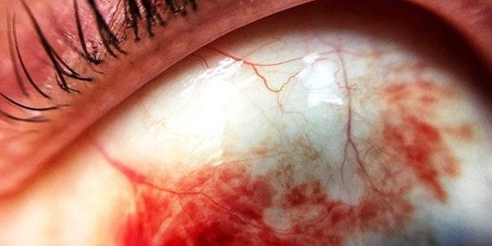 Kenalan Yuk Sama Uveitis, Penyakit Radang Pada Mata | Bersosial.com